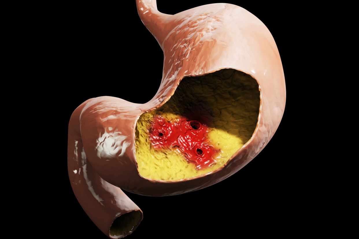 胃癌早期有什么症状早期胃癌什么症状