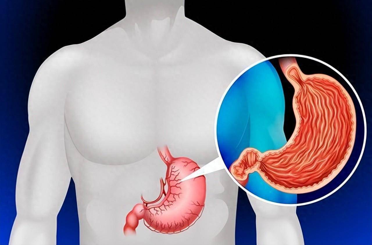 早期胃癌有哪些症状「如何识别早期胃癌的征兆」