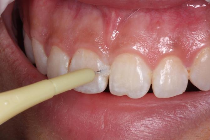 牙齿变白的有效方法有哪些，如何快速让牙齿变白
