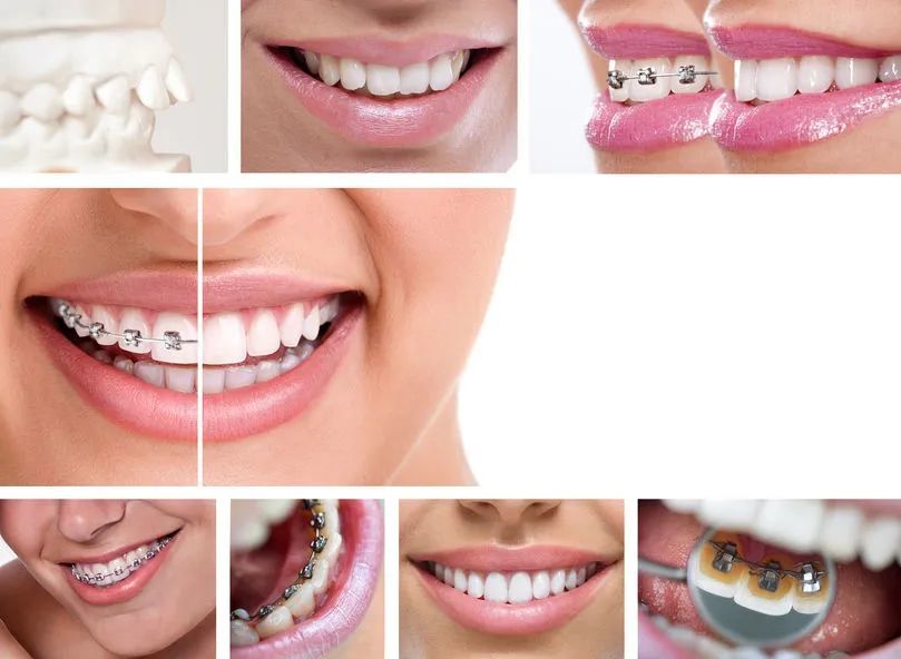 牙齿矫正方法有哪些「如何选择适合自己的牙齿矫正方法」